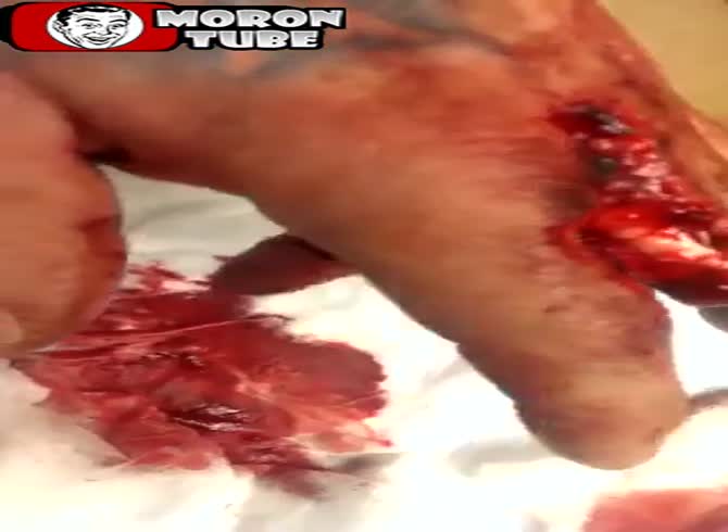 Video :His finger was severed in a table saw accident (public notified)